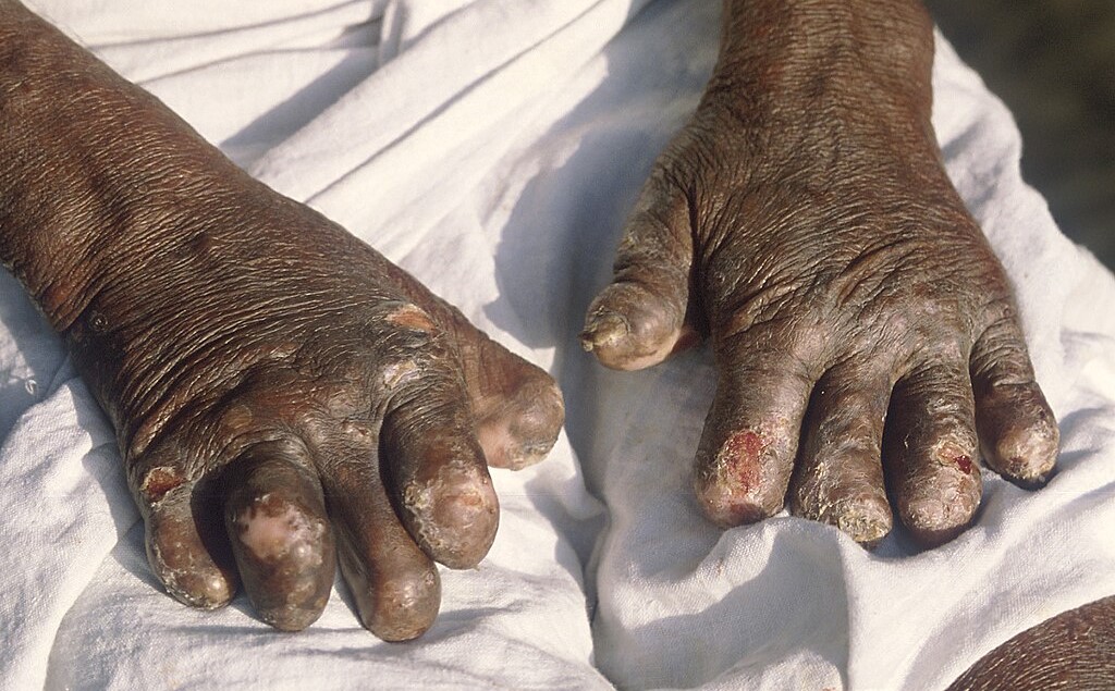 a pair of hands with leprosy